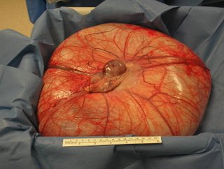 Thats not an ovarian cyst . . . Thats not an ovarian cyst . . .