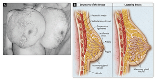 Benign diffuse breast hyperplasia