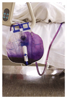 Mmm . . . purple urine