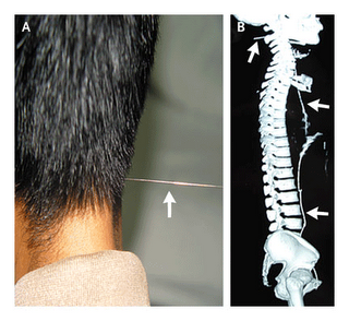Guide wire sticking out from neck