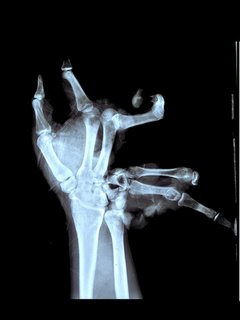 Hand meets explosive device Hand meets explosive device