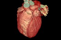 Cardiac scans are not ready for prime time