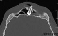 Tooth in the frontal sinus
