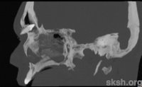 Tooth in the frontal sinus