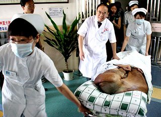 A 33 pound facial tumor A 33 pound facial tumor
