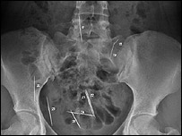 Sewing needles embedded in a 31 year old