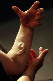 Ear implated in arm