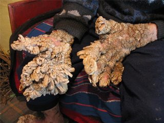 Lewandowsky Lutz dysplasia Lewandowsky Lutz dysplasia