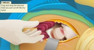 Virtual hip replacement
