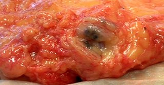Inguinal lymph node dissection