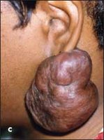 When ear piercings lead to keloid formation