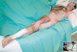Limb attached to crotch