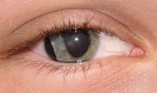 Eye injury