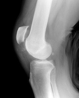 Patellar tendon rupture