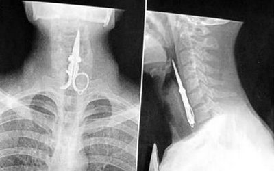 What happens if you swallow a pair of scissors