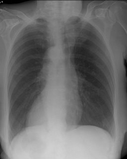 Situs inversus