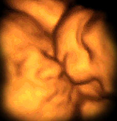 4 D ultrasound twin images in utero