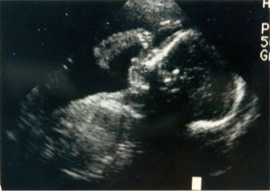 The ultrasound that saved a baby girls life