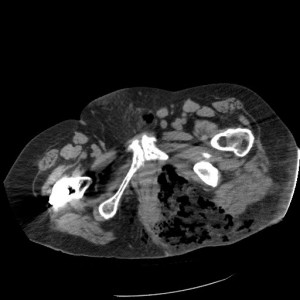 Treating Fournier gangrene, or necrotizing fasciitis of the male genitals