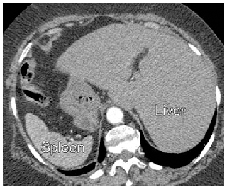 Situs inversus, and the difficulty of operating on patients with reversed anatomy