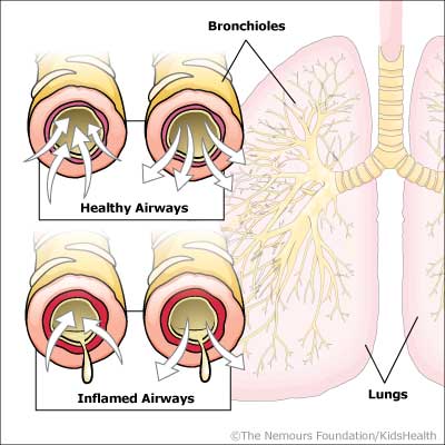 A New Drug To Treat Rsv Bronchiolitis