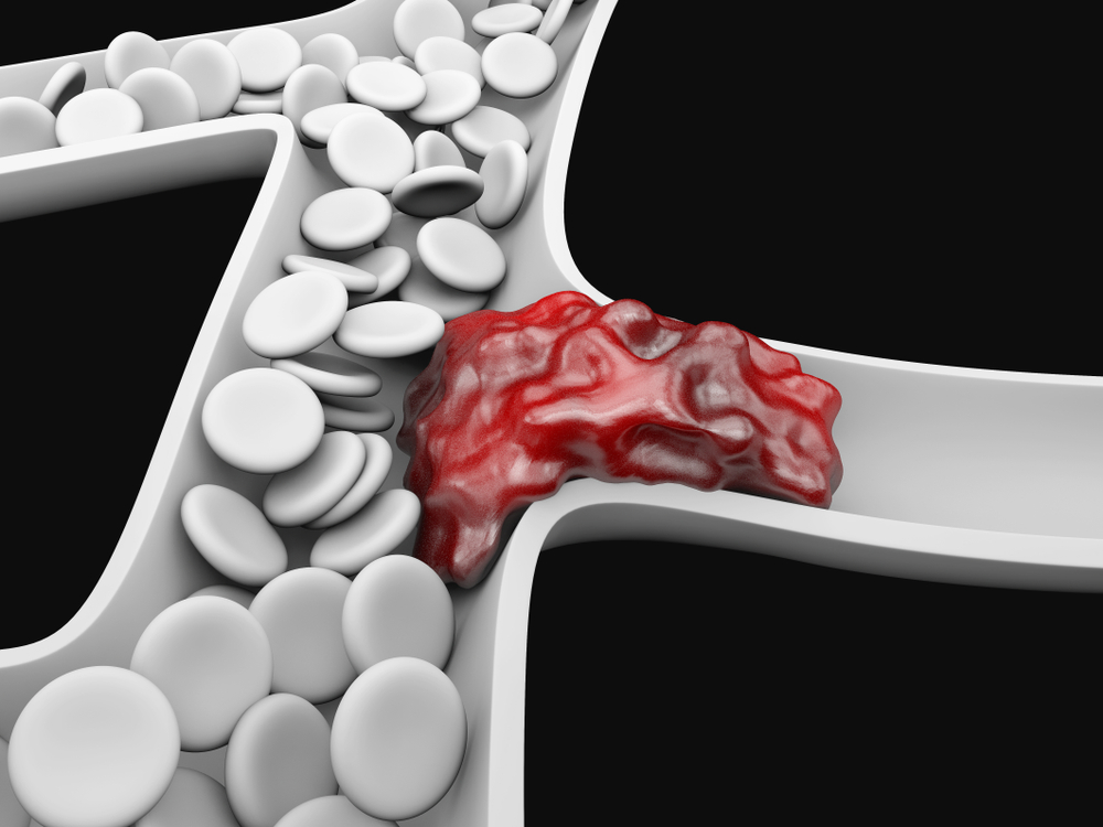 Pulmonary embolism the killer clot in your veins
