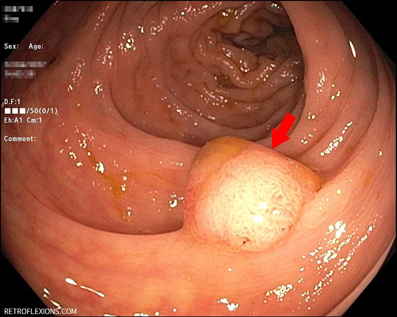 What you should know about colon polyps