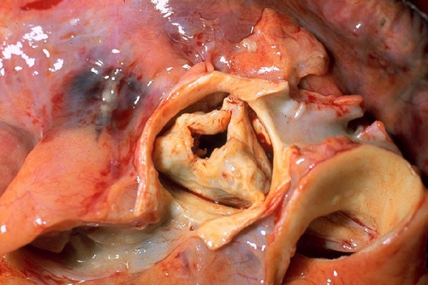 Aortic_stenosis_rheumatic,_gross_pathology_20G0014_lores