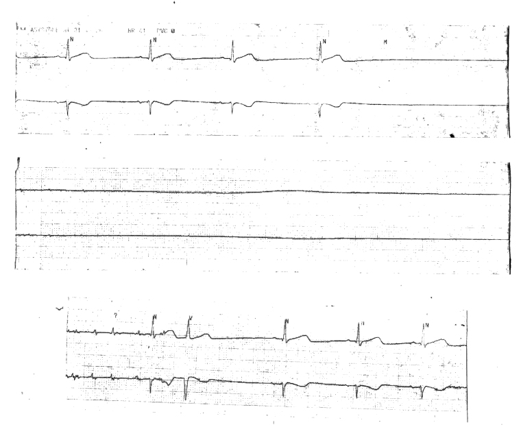 Asystole