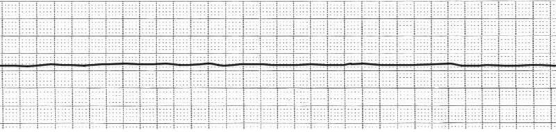 EKG_Asystole