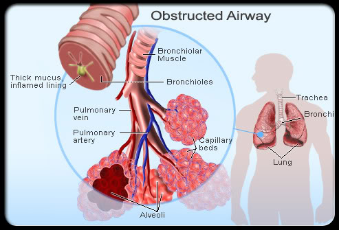 asthma-s5-bronchioles-inflamed