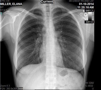 cxr2