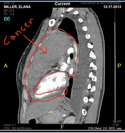 lymphoma