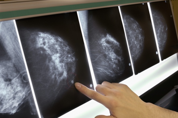 mammogram breast cancer screening