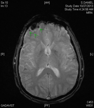 mri-ax-susc-image-24-10-27-13