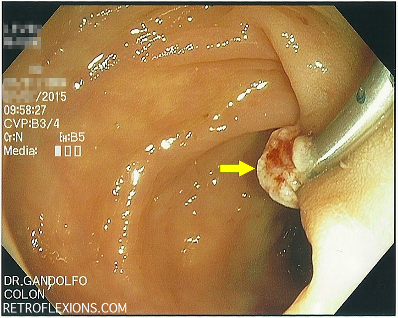 sigmoid-polyp-2